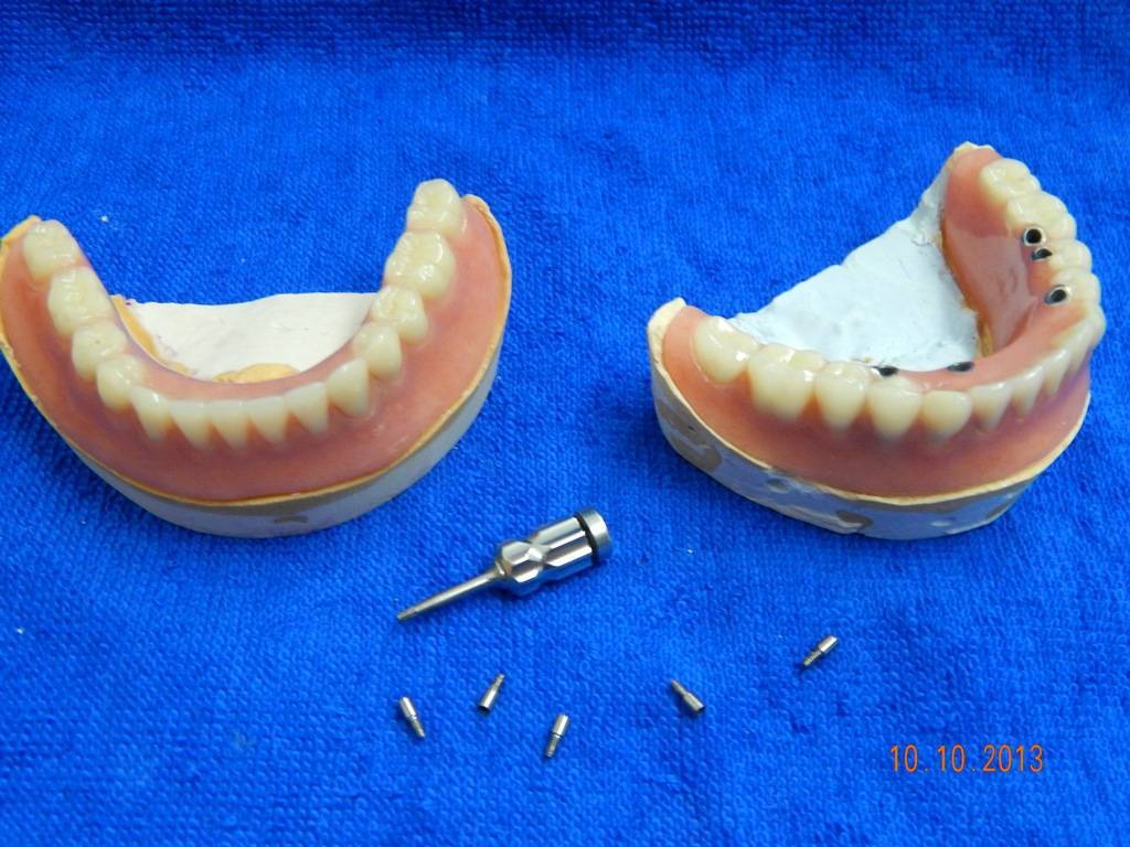 Какие зубные протезы лучше при отсутствии зубов. Зубопротезирование нижней челюсти 44.45 .47. Протезирование зубов.