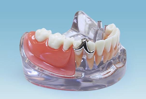 Протезирование зубов виды. Съемный протез. Ортопедический зубной протез. Протезы в ортопедической стоматологии.